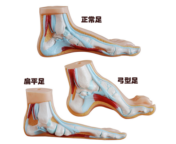 正常足、扁平足、弓型足模型